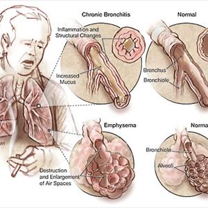 Bronchitis Blood Test - Overcoming Bronchitis And Its Health Effects