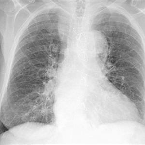 Trachial Bronchitis - Viral And Bacterial Bronchitis - Revealing The Differences