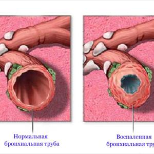 Symptoms Of Asthmatic Bronchitis - Natural Bronchitis Remedies - Acute