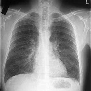 Tracheal Bronchitis 