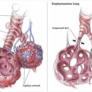 Preventing Bronchitis - Home Remedies For Bronchitis - Which Remedies Do Wonders