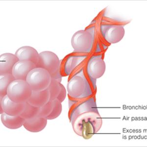 Bronchitis Condition - Causes Of Bronchitis And Symptoms Of Bronchitis