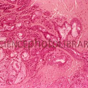 Bronchitis Bacterial Treatment - Bronchitis With Asthma - Understand Significant Facts