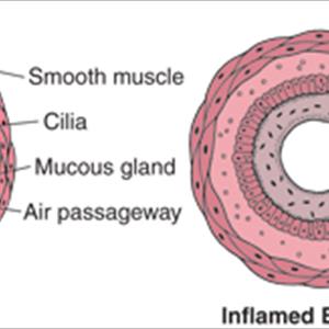  Bronchitis 