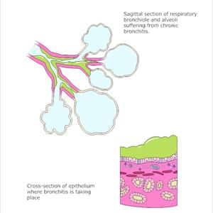 The Effects Of Bronchitis - 7 Simple Bronchitis Treatment Tips