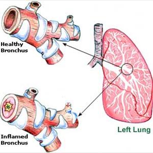 What Is Trachial Bronchitis - Asthma And Chronic Bronchitis - Causes And Cures