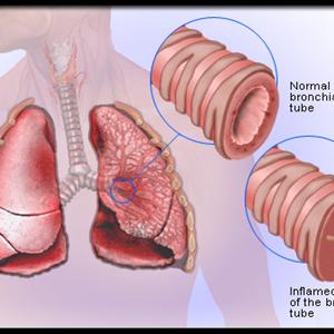  Bronchitis In Children 