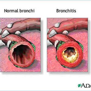 Acute Bronchitis Symptom 