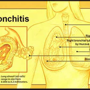 Lower Back Pain Bronchitis 