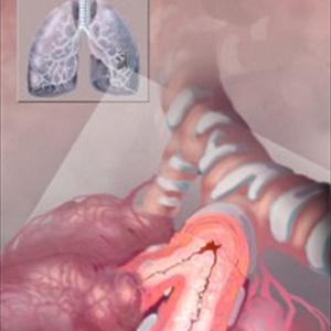  The Management And Treatment Of Chronic Bronchitis