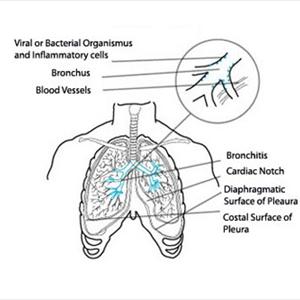 Home Treatment For Bronchitis - Conventional Medical Treatment For Bronchitis