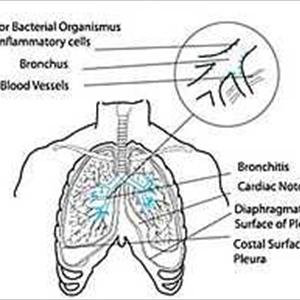 Bronchitis Contageous - Chronic Bronchitis Prevention - Protect Yourself