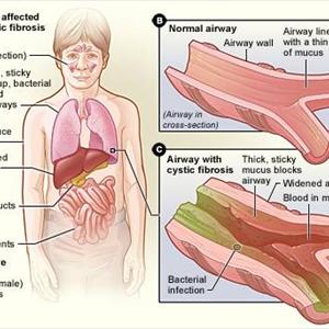  COPD Progression