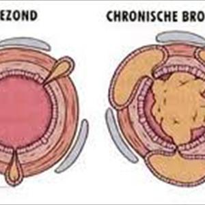 Bronchitis Lead To Asthma - Herbal Remedies For Cough And Bronchitis