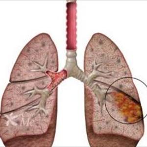  Asthmatic Bronchitis Explained 