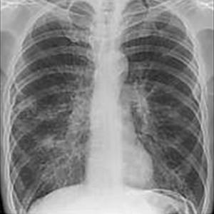 Acute Asthmatic Bronchitis Treatment 