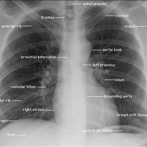 Description Bronchitis Bronchiolitis 