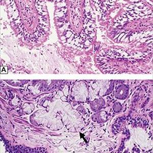  Tracheal Bronchitis  