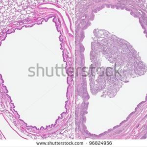 Typhoid Fever Bronchitis 