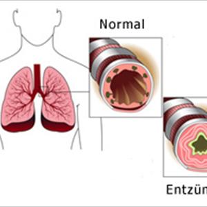 Acute Severe Bronchitis - Causes And Risk Factors Of Acute Bronchitis