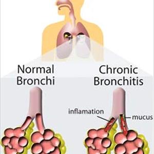 Homeopathic Bronchitis Remedy - A Common Disease - Bronchitis