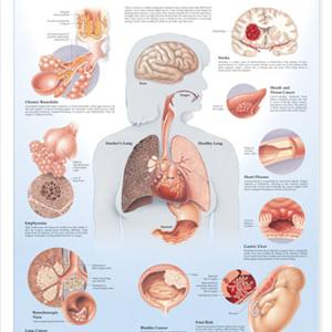 Definition Of Bronchitis 